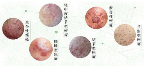 痤疮的种类